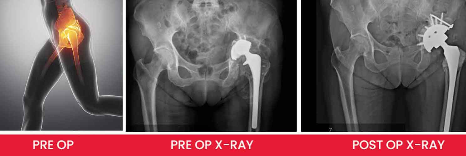 hip replacement pre and post