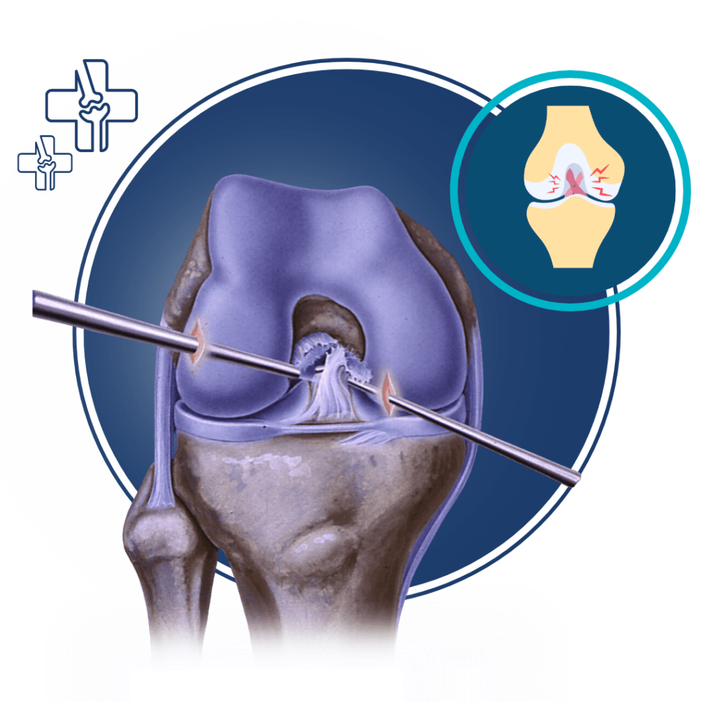 Best ACL Surgeon in Jalandhar